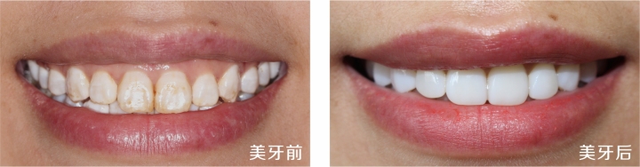 专业团队进行牙齿贴面设计与操作