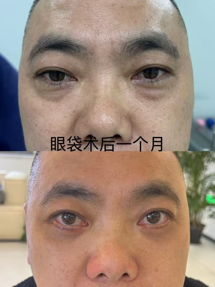 提眉术后效果对比