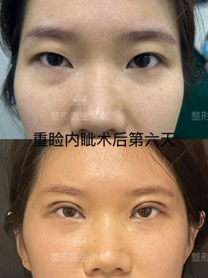 邓京汉案例术前术后对比动态展示