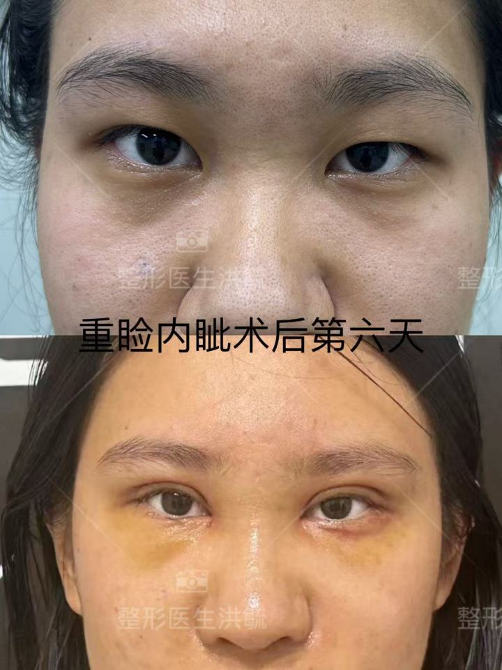 眼部精雕手术示意
