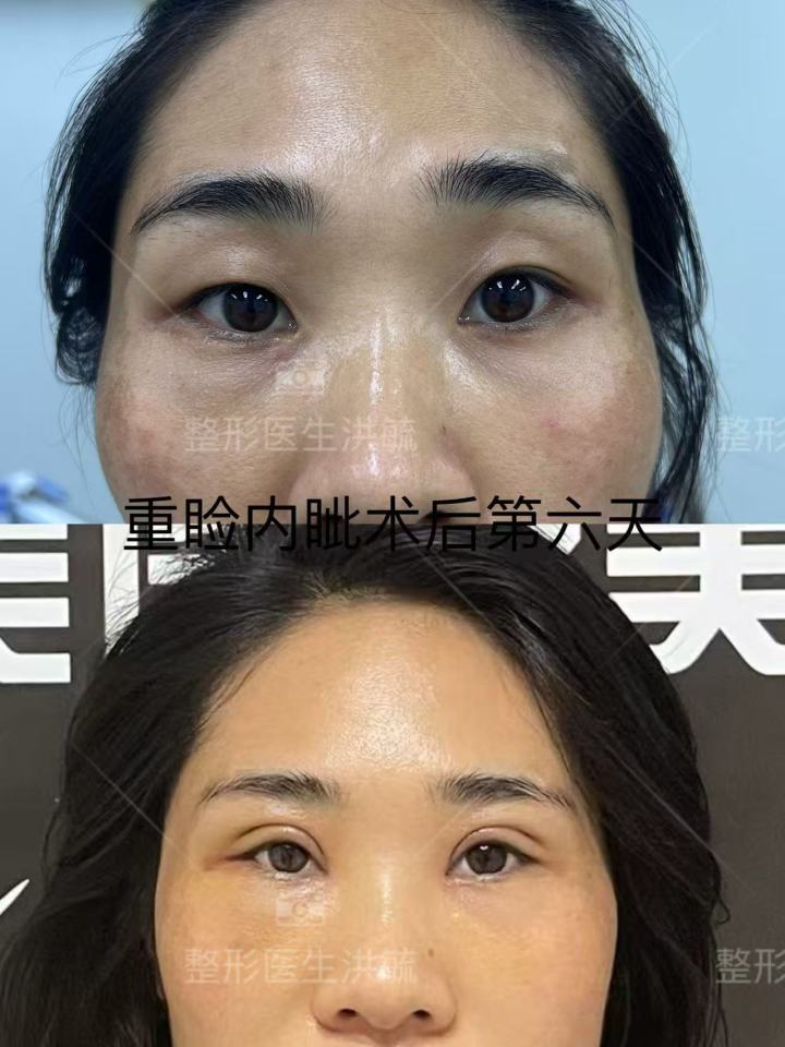 原生双眼皮效果展示