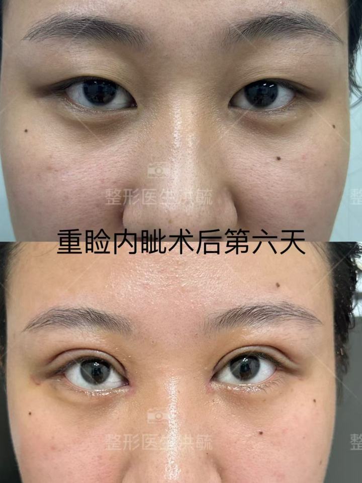 眼部修复术后效果对比