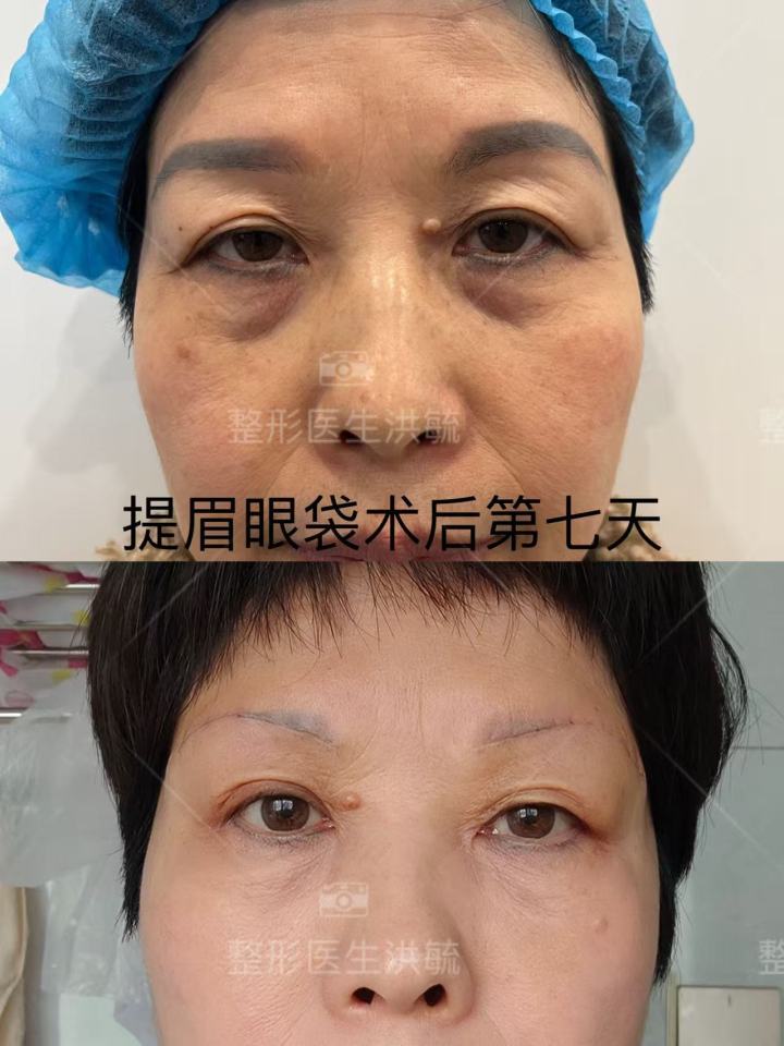 眼部精雕手术案例