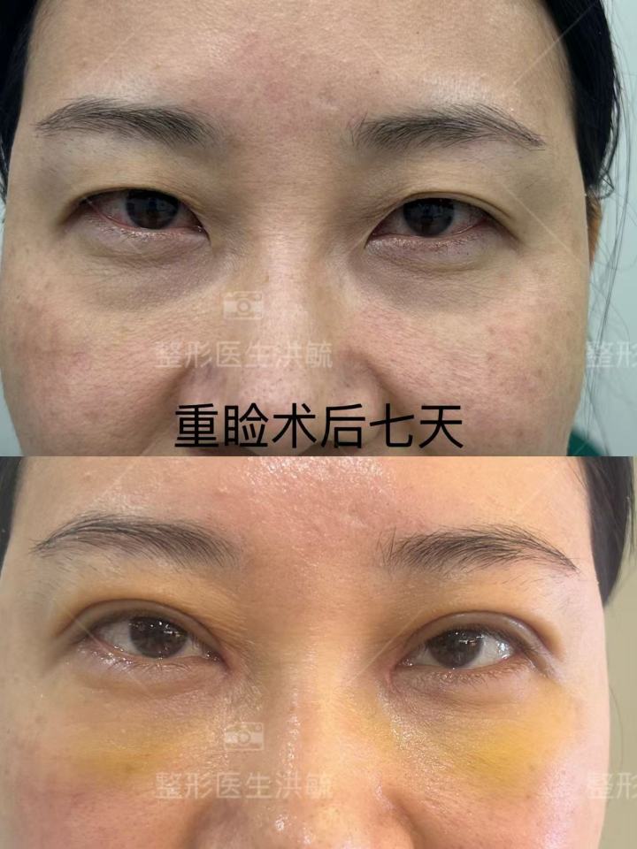 双眼皮案例展示
