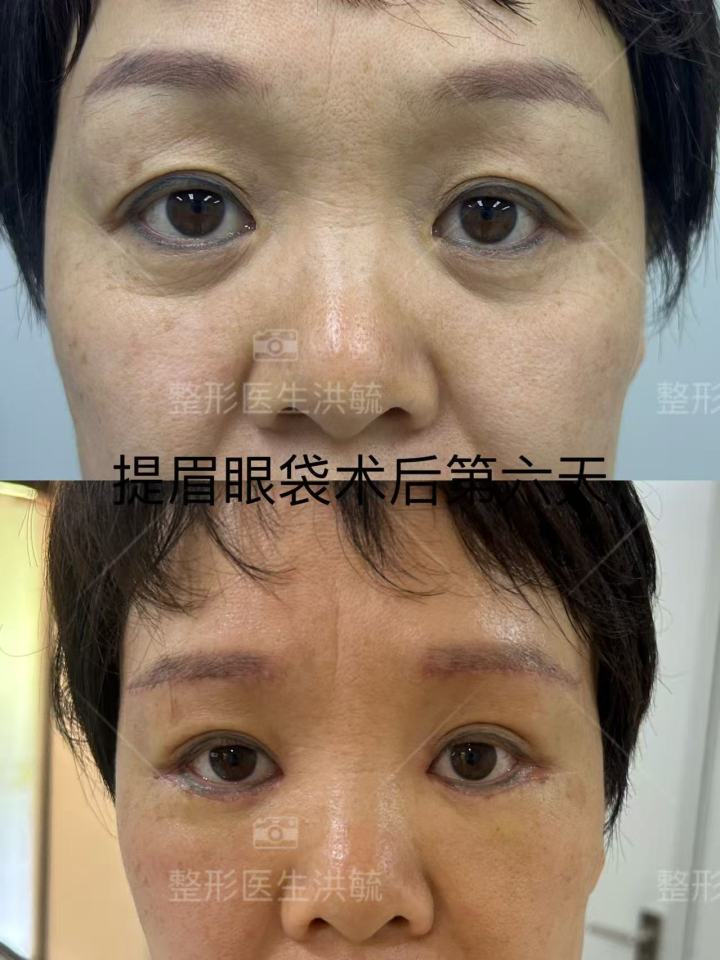 洪毓院长在进行精细眼部手术