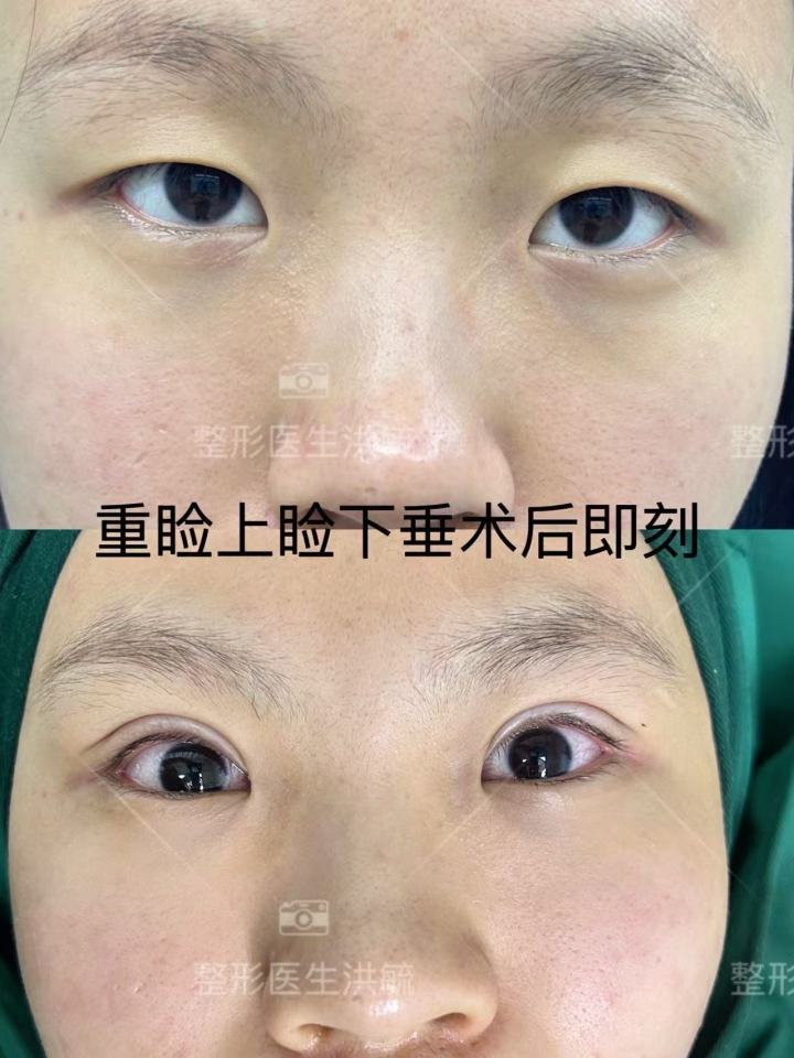提眉术后恢复细节