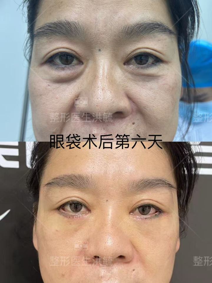 眼部修复术前术后对比