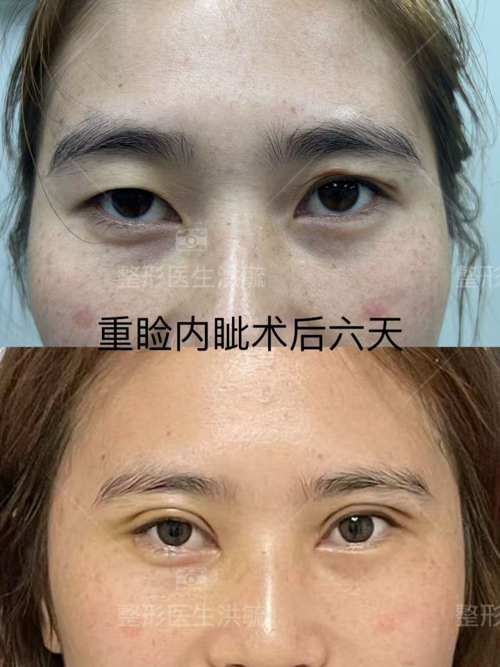术后恢复效果展示