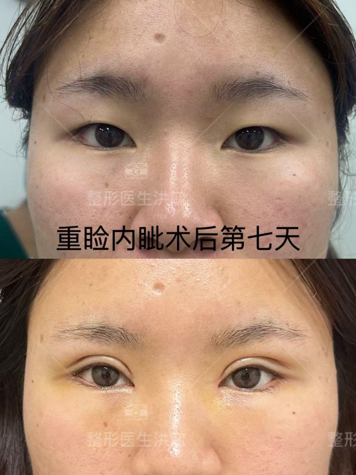 埋线双眼皮术前术后对比