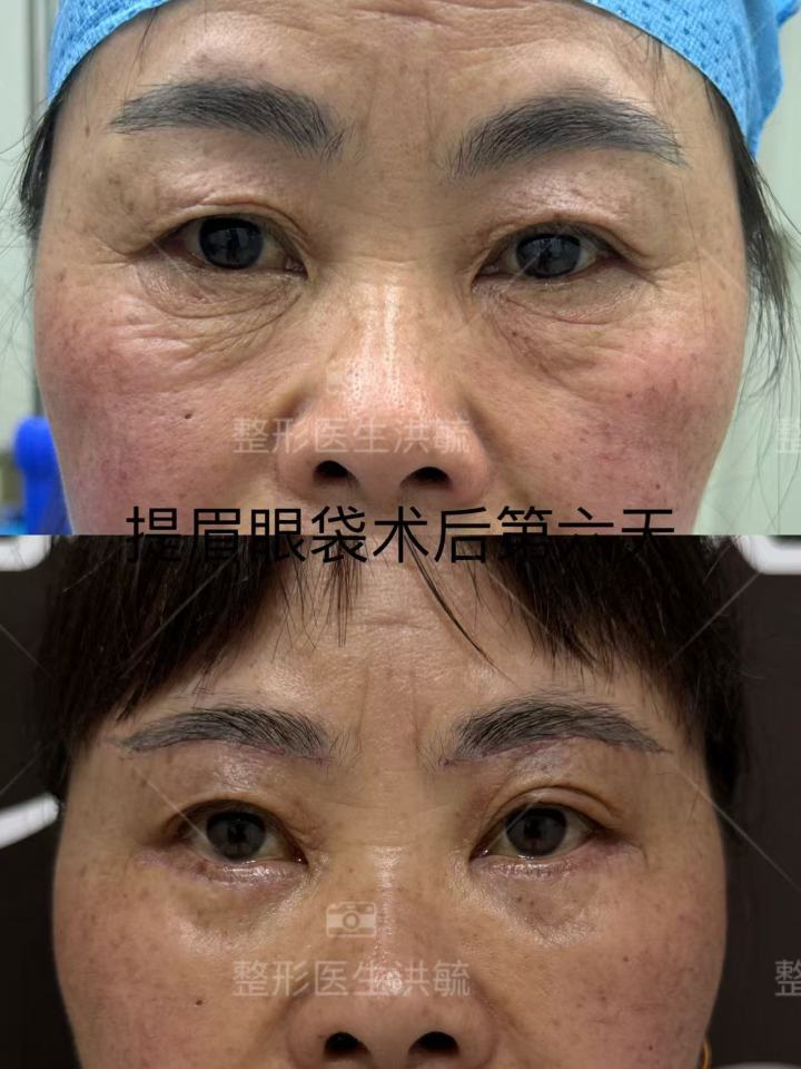 术后效果展示