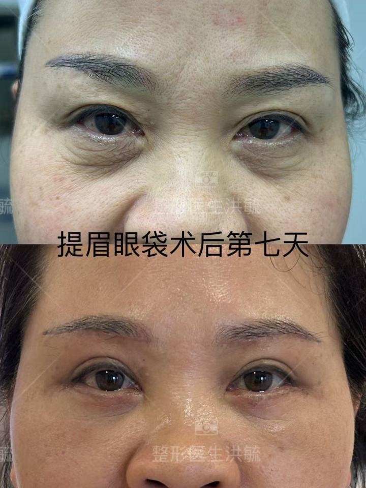 双眼皮手术示意图