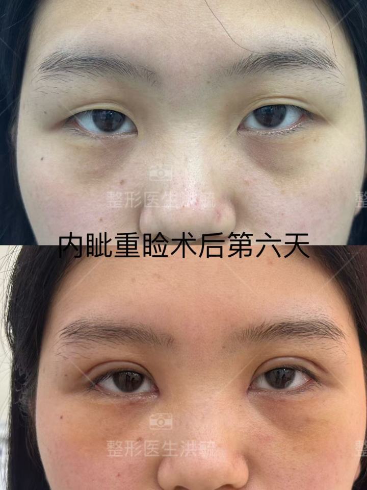 眼部修复案例示意图