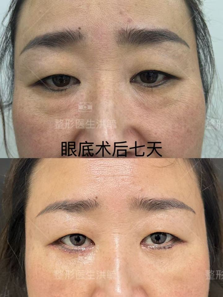 专业手术操作示意