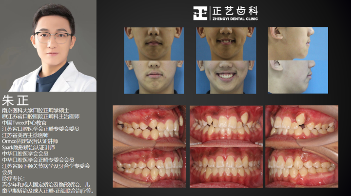 案例-拥挤不拔牙矫正 (7).png