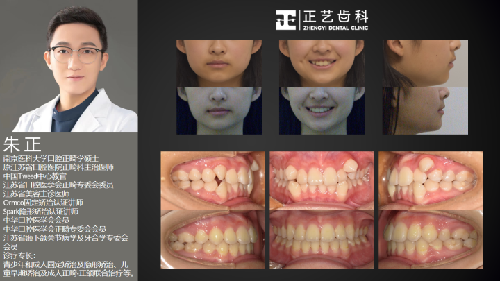 案例-拥挤拔牙矫正 (6).png
