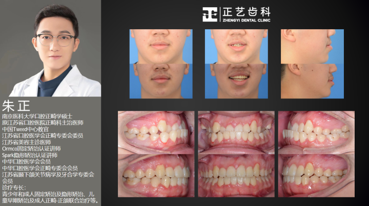 案例-反合正畸矫正 (4).png