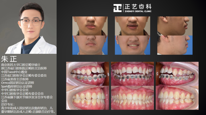 案例-牙齿开颌矫正 (3).png