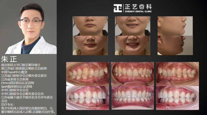 案例-深覆颌矫正 (1).png