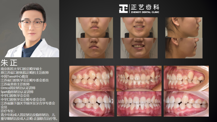 案例-拥挤拔牙矫正 (8).png